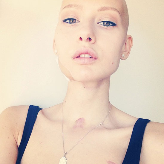  Elizaveta Bulokhova Pregnant Model Diagnosed Of Jaw Cancer